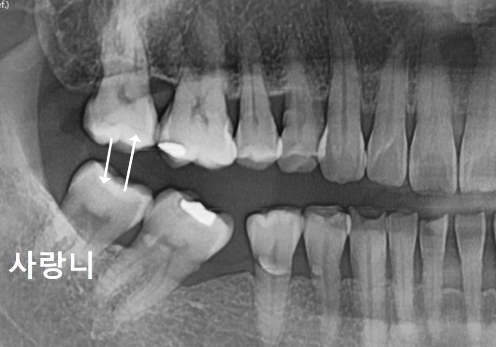 발치 후 빈 공간, 이 빼고 오래 냅두면 이렇게 됩니다. 관련 이미지 5