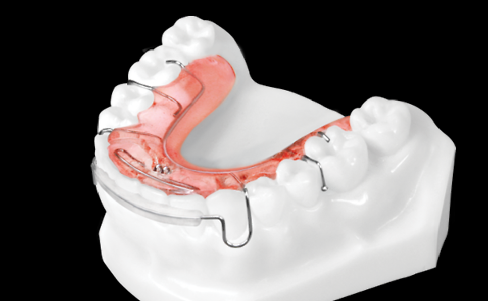 Two Types of Retainers Are Needed After Orthodontic Treatment: Bonded and Removable image 6