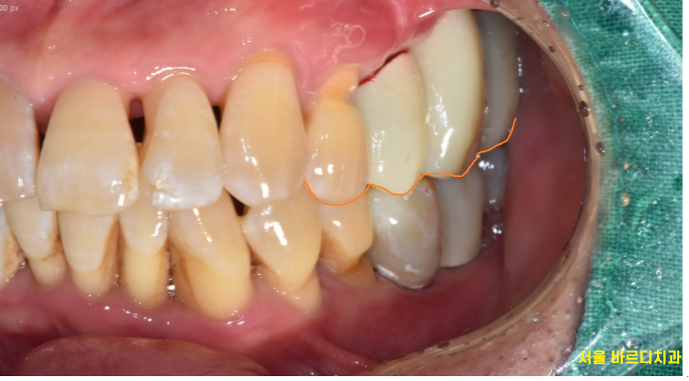 망월동 치과 임플란트 보철 불편 볼 씹힘, 이질감 그 사이에서 관련 이미지 5