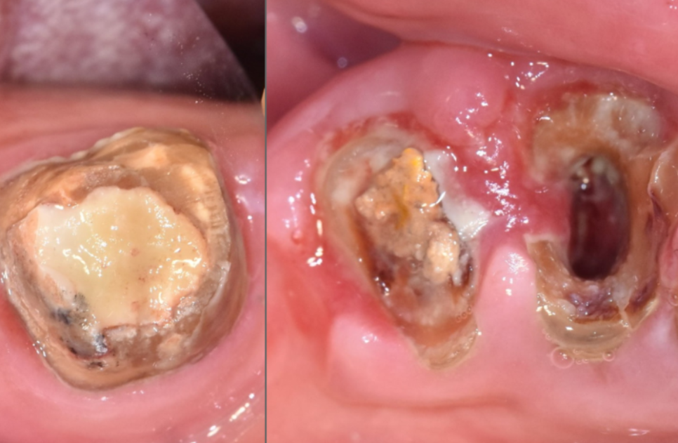 오래된 어금니 롱브릿지, 교체 타이밍을 놓치면 관련 이미지 10