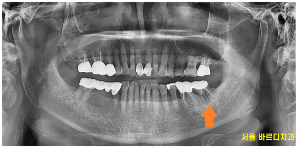 천호동 임플란트 치아 뿌리 충치가 파절을 유발하다. 관련 이미지 2