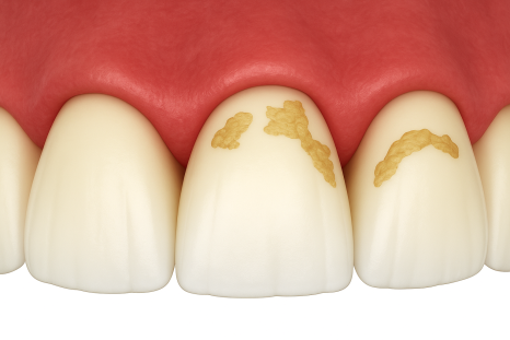 스케일링했더니 잇몸 구멍, 치아 사이 구멍이 생겼어요. 스케일링에 관한 오해 3가지 관련 이미지 2