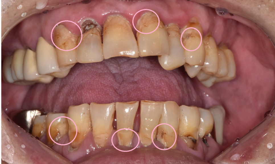 녹아버린 잇몸뼈 흔들리는 여러 치아 발치 후 임플란트 시행 관련 이미지 3