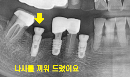 타치과 임플란트 as 수리 가능한 선동치과 관련 이미지 6