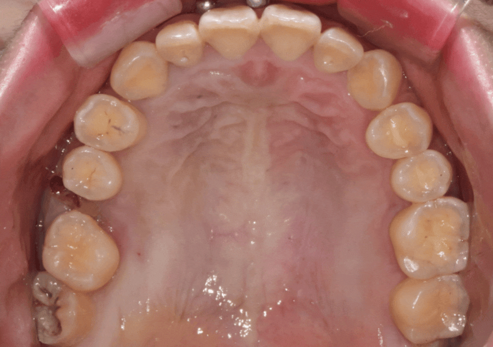Myeongil-dong Implant Treatment in Your 20s: The Reason It Ended Up Requiring Bone Grafting After Thinking, “I’m Young, So It’ll Be Fine” image 15