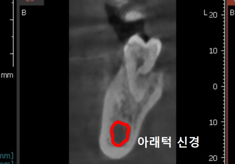 강동구 잇몸 퇴축으로 뿌리 드러난 치아, 이대로 둬도 괜찮을까? 관련 이미지 11