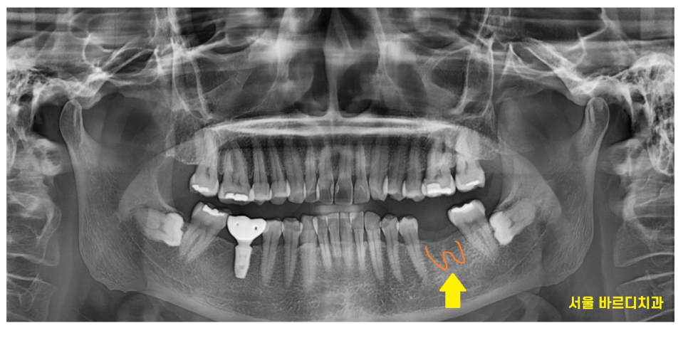 풍산동 치과 아래 어금니 임플란트 뼈 이식 없이 해결했습니다. 관련 이미지 2