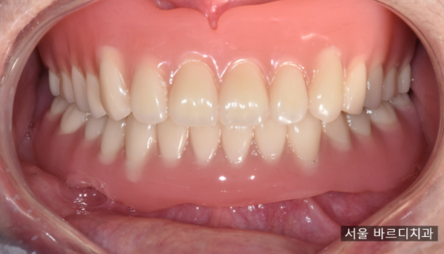 임플란트 틀니 치아가 없을 때 하남미사치과에서 해결하세요. 관련 이미지 6