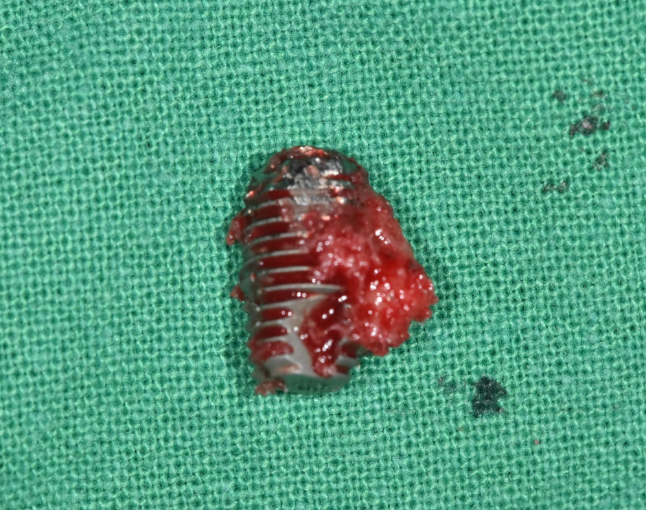 임플란트 잇몸 염증 주위염 증상이 늦게 나타납니다. 관련 이미지 1