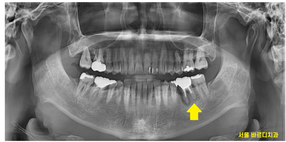 고덕역 치과 치아뿌리 파절 부러짐 있을 때 임플란트로 대체해야죠 관련 이미지 2