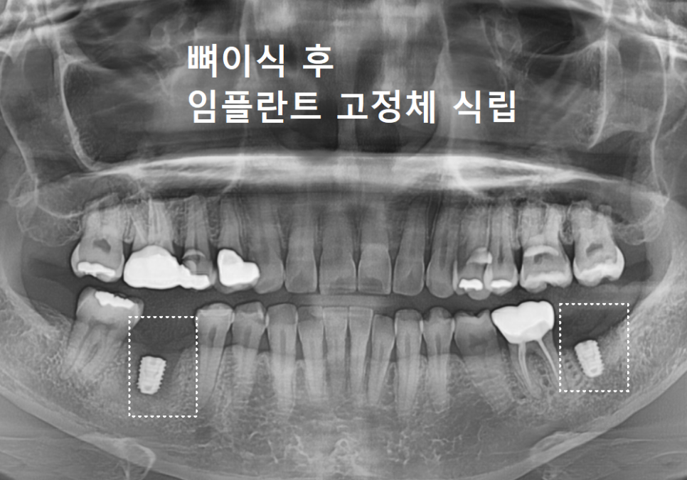 고덕역 임플란트, 뼈이식 꼭 해야 할까? 필수 상황 vs 제외 상황 총정리 관련 이미지 12