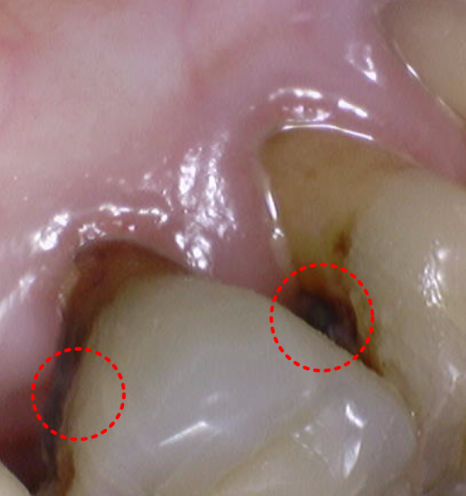 상일동 임플란트 심한 충치로 인한 치아 부러짐 해결한 사례 관련 이미지 11