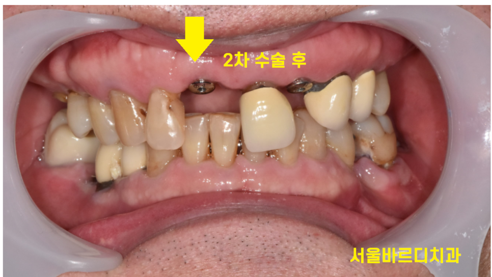 임플란트 2차 수술 과정 아직도 안끝났어요? 죄송합니다!! 관련 이미지 6