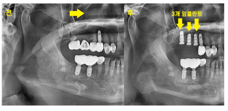 고덕동 치과치료 씌운 치아 문제가 생겼어요 관련 이미지 8