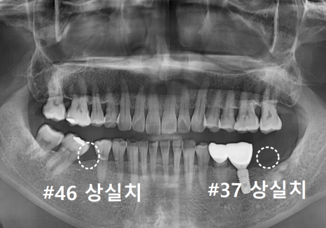 발치 후 빈 공간, 이 빼고 오래 냅두면 이렇게 됩니다. 관련 이미지 9