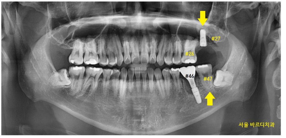 암사동 치과 임플란트 꼭 안 해도 되는 경우 궁금증 해결해 드려요 관련 이미지 9