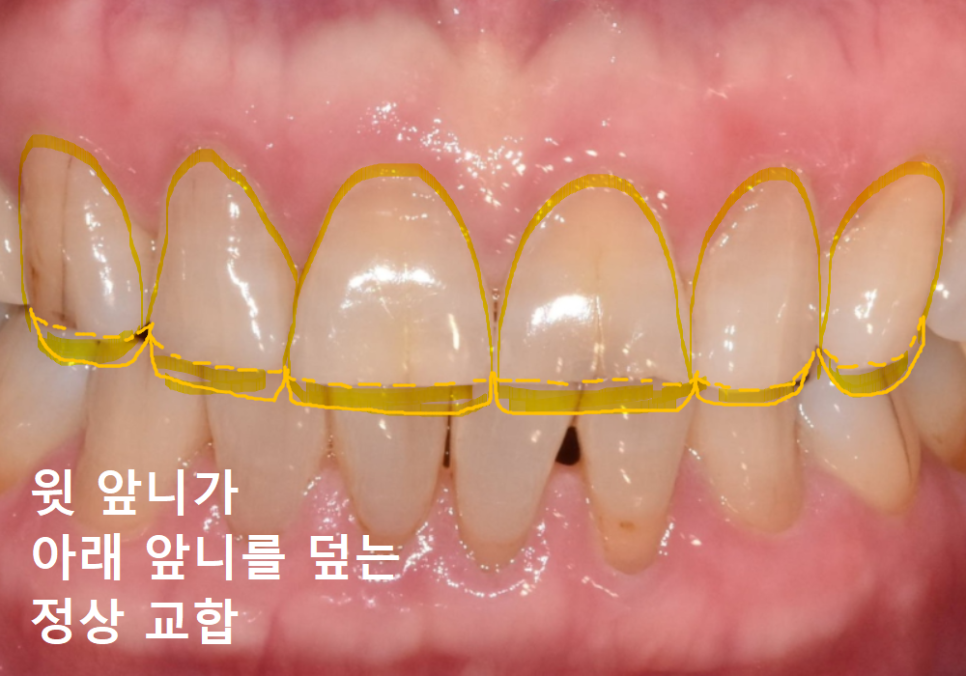 앞니 세로 줄, 똑같은 금이라도 진단 결과가 180도 다른 이유 관련 이미지 8