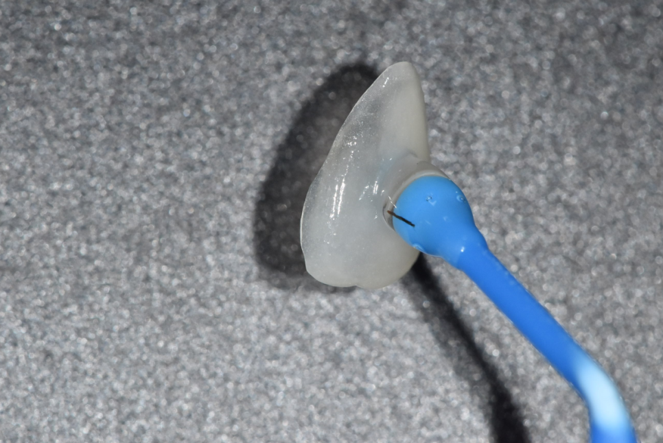 앞니 레진 변색으로 무삭제 라미네이트 진행했습니다. 관련 이미지 6