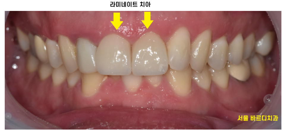 상일동 라미네이트 과연 진짜 안좋을까??? 교정, 크라운과 비교해보았습니다!! 관련 이미지 3