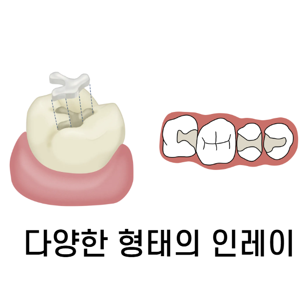 하이브리드 인레이 치아 사이 충치 치료할 때 사용됩니다. 관련 이미지 1