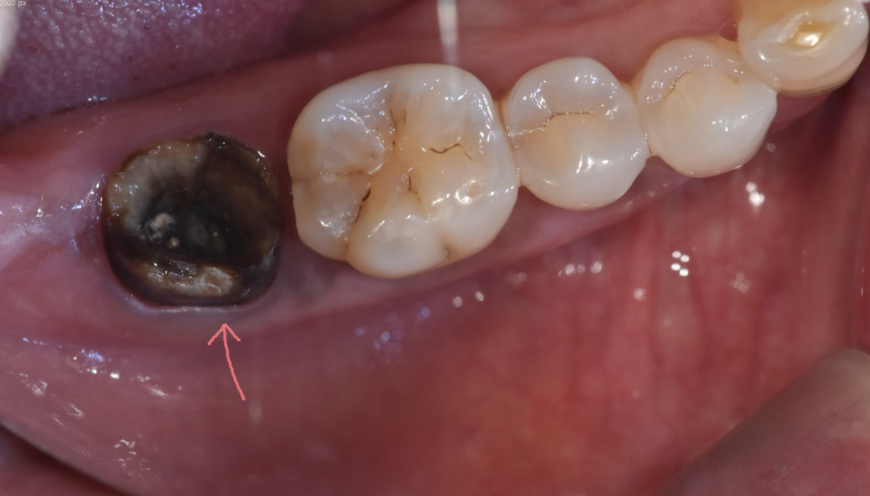 치아 크라운 빠짐 내부 충치가 심할때는 임플란트가 필요합니다. 관련 이미지 3