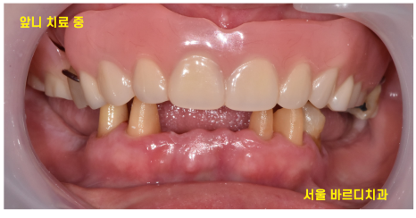 전체적인 치아 치료 13개의 임플란트를 식립한 환자분 관련 이미지 9