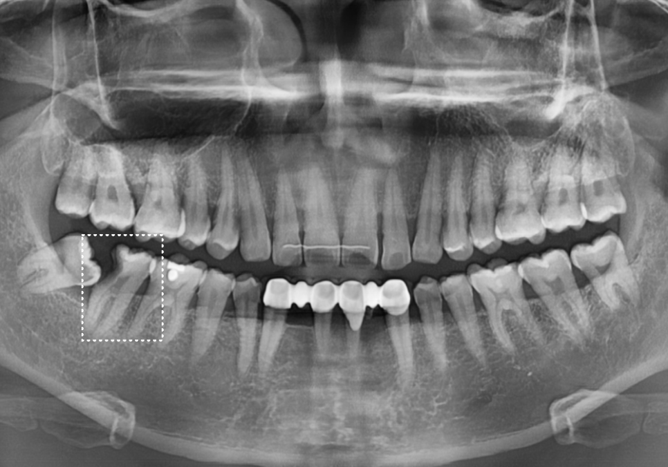 수평 매복 사랑니, 옆으로 누운 사랑니 때문에 멀쩡한 어금니까지 뽑은 사연 관련 이미지 1