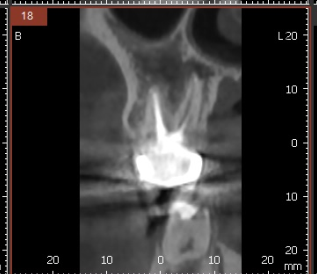 발치 대신 신경치료 뽑기 전 치료는 한번 해봐야하지않을까요? 관련 이미지 13