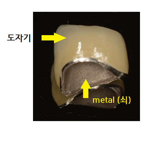 천호동 치과 임플란트 크라운 종류 설명 나갑니다. 관련 이미지 5
