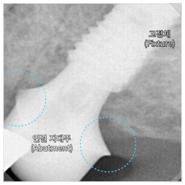 빠진 크라운 크라운 탈락이 알려주는 3가지 신호 관련 이미지 10
