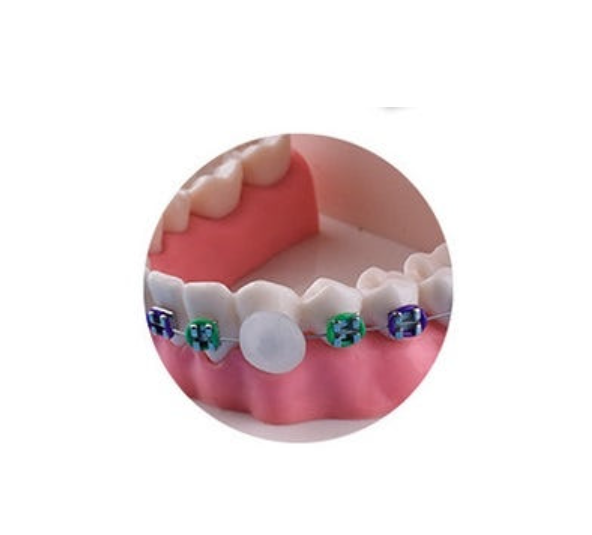 교정기 철사 찔림 원인과 대처법은? 관련 이미지 4