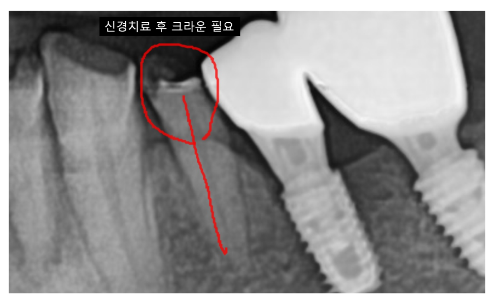 금간 치아 통증 심할 때 발치와 임플란트가 필요한 이유 관련 이미지 2