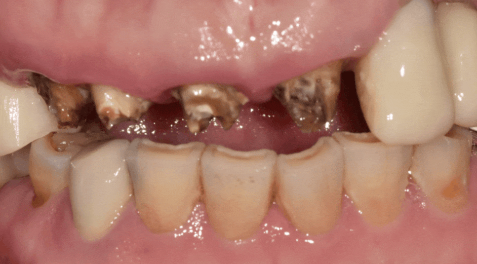 앞니 브릿지 탈락, 씌워둔 게 빠졌어요. 다시 붙일 수 있을까요? 관련 이미지 17