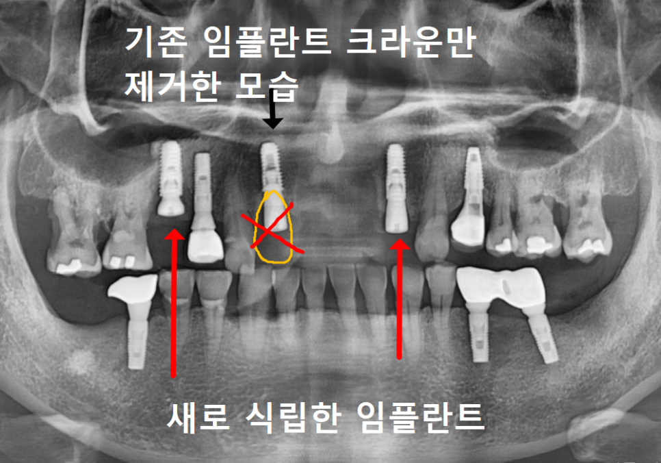 앞니 흔들림, 임플란트 치아보험 감액 기간 넘기려다 더 큰 손해 봅니다. 관련 이미지 10