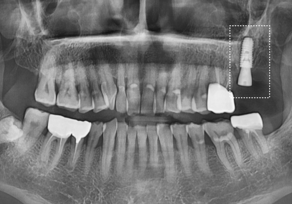 어금니 금 감, 치아 살릴 수 있는 기준은 바로 관련 이미지 12