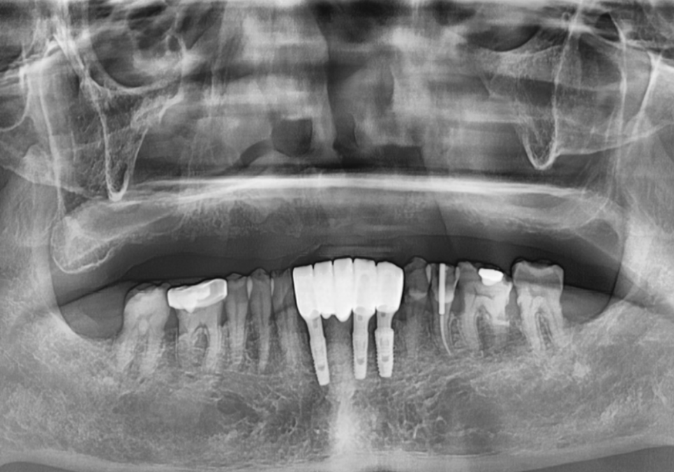 뼈가 없어서 안 된다구요? 70대 당뇨 무치악 환자분의 전체 임플란트 사례 관련 이미지 3
