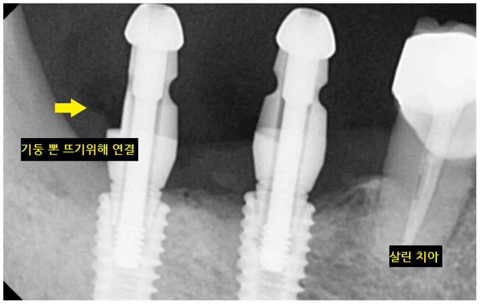 강일역 치과 치아와 임플란트 연결 가능한가요??? 관련 이미지 7