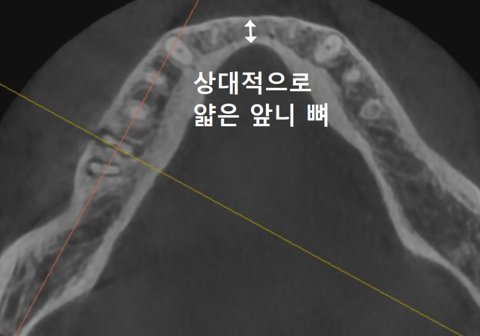 앞니 잇몸 꺼짐, 잇몸 이식 없이도 임플란트 할 수 있는 방법 공개합니다. 관련 이미지 1