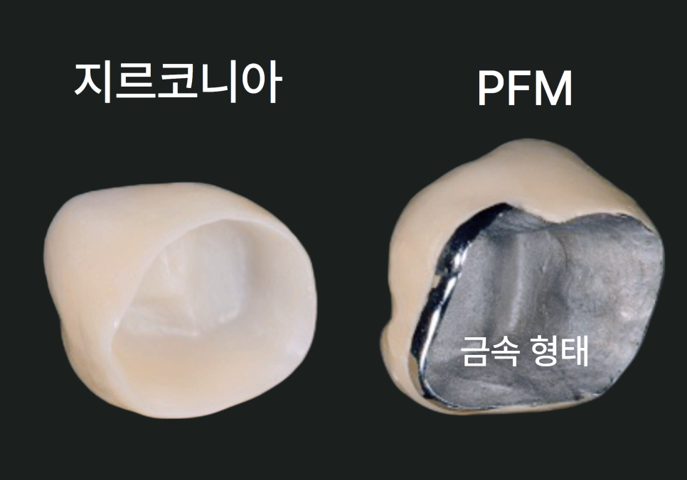 잇몸 까매짐 원인,증상,치료 방법 오래전에 앞니 씌운 곳 잇몸이 까매졌어요. 관련 이미지 1