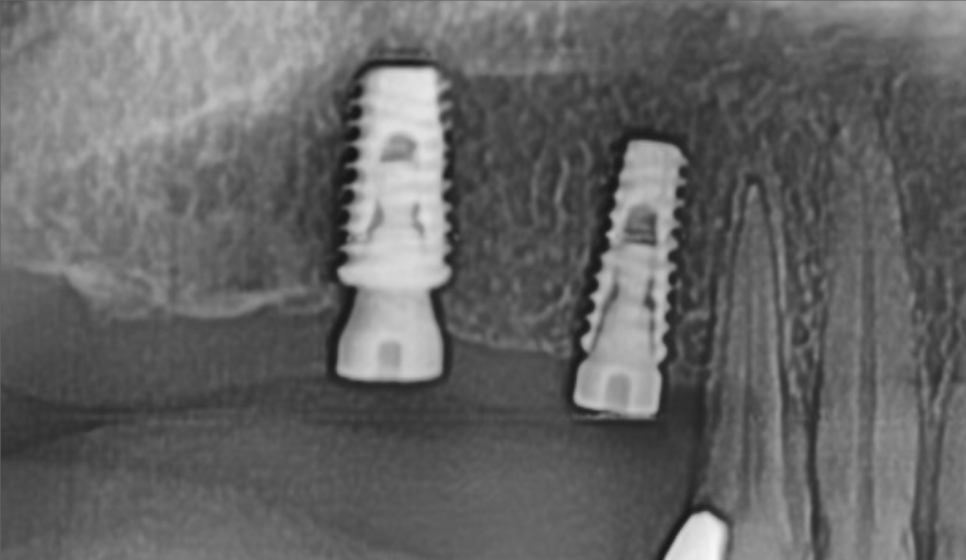 오늘 임플란트 심고, 내일 씹는게 가능하다고요?? (잔존골은 정답을 알고있다) 관련 이미지 4