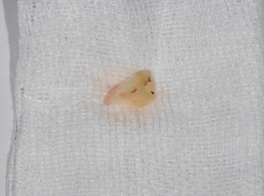 초이동 치과 치아 실금으로 조각나 신경치료까지 진행했습니다. 관련 이미지 1