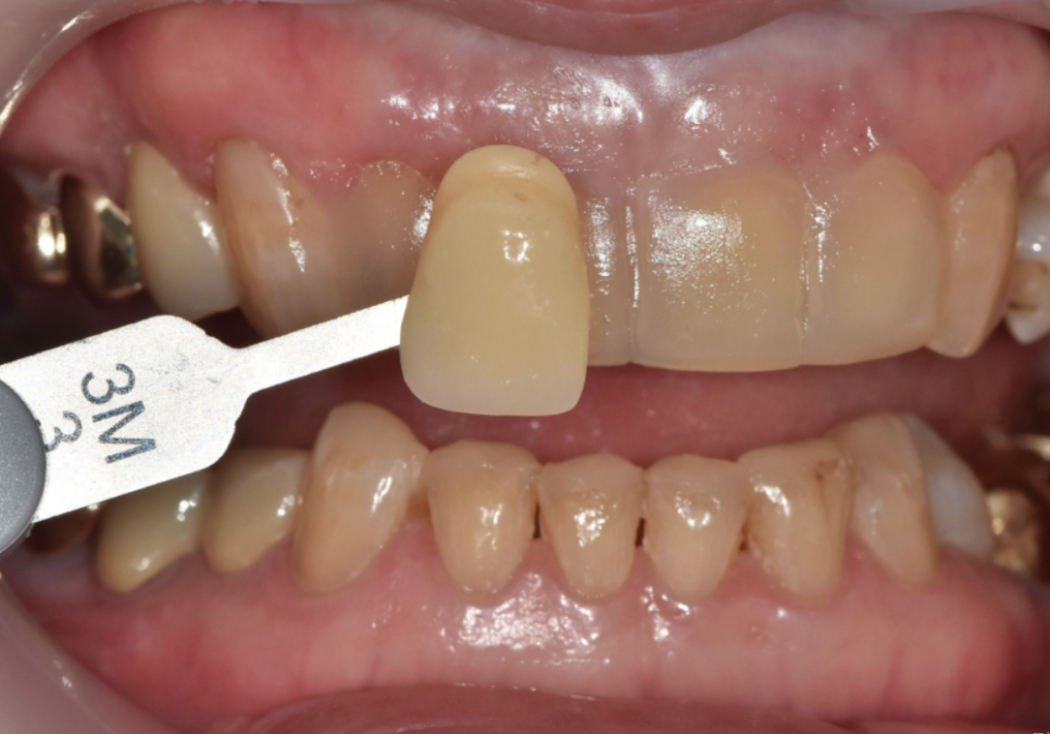 중장년 라미네이트, 70대도 가능한가요? 왜소치와 벌어진 앞니 해결 사례 관련 이미지 12