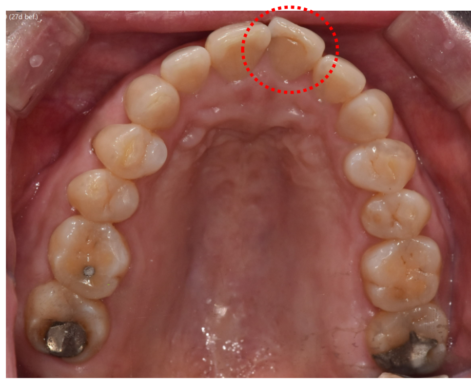 The Moment You Decide on Orthodontic Treatment in Your 50s Is the Fastest image 2