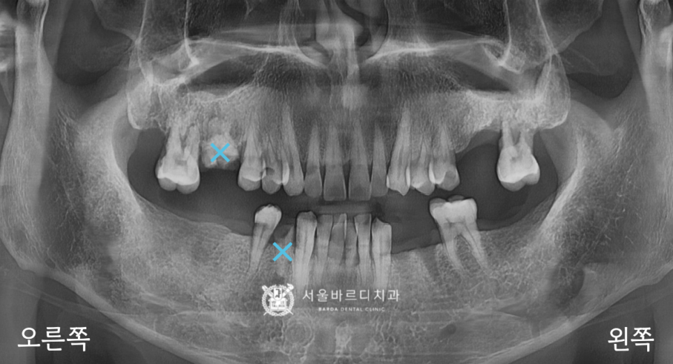 고덕동치과 서울바르디치과 무절개 네비게이션 임플란트 치료증례 #1 관련 이미지 7