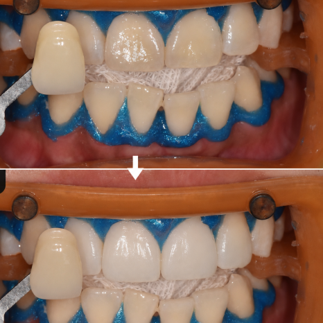 Some Discoloration Cannot Be Resolved with Whitening (Whitening vs. Veneers) image 2