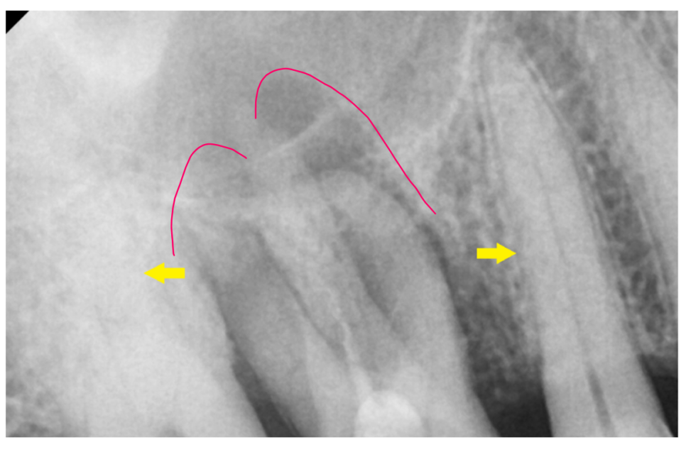 Is It Difficult to Shorten the Implant Procedure Period? Why It Differs from Person to Person image 4