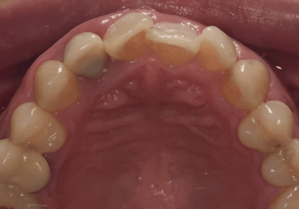 앞니 덧니, 교정은 싫고 시간은 없다면? 라미네이트로 해결한 사례 관련 이미지 7