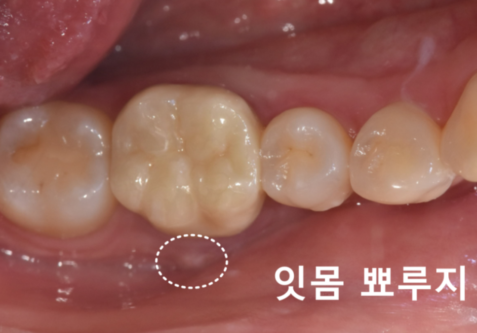 강동구 치아 뿌리 염증, 신경치료 한 치아인데도 아플 수 있나요? 관련 이미지 4