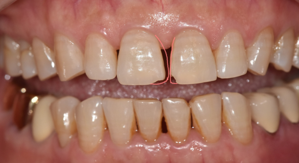 깨지고 벌어진 앞니 사이 레진으로 공간 재분배하였습니다. 관련 이미지 4