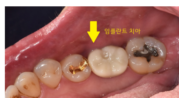 상일동 임플란트 수술 과정 시작부터 끝까지 따라와주세요! 관련 이미지 8